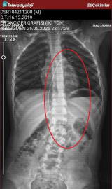 Salatalık yutunca rahatsızlandı; 3 yıl önce vücudunda 18 santimlik kateter unutulduğu ortaya çıktı