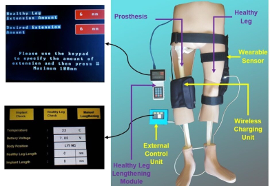 Türk akademisyenler, kemik kanseri tedavisi için tümör protezi geliştirdi