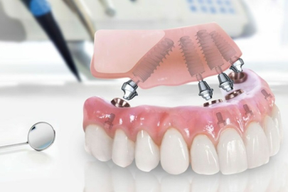 Gelişen implant teknolojisi yeniden güldürüyor!