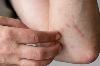 Tahtakurusu Isırığına Ne İyi Gelir?