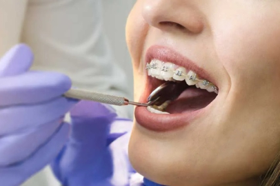 Diş Teli Tedavisi Nedir? Kimlere ve Ne Zaman Uygulanır?