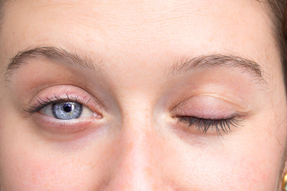 Yüz Felcinde Soğuk Hava Masum mu?