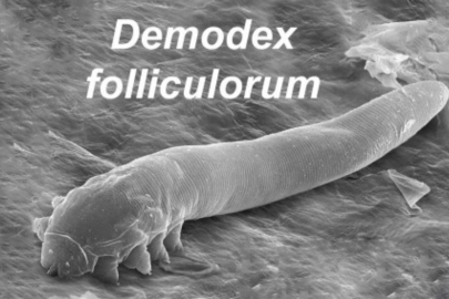 Gözünüzdeki 'Gizli Kiracı'ya Dikkat: Yanma ve Kaşıntının Sebebi O Olabilir!