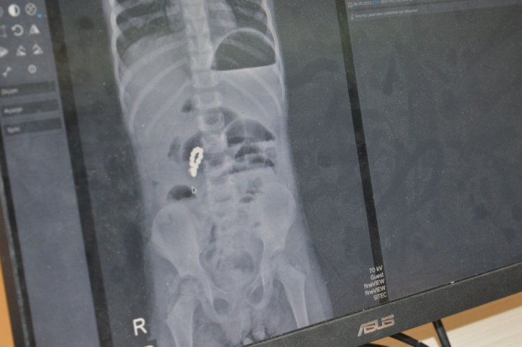 Anne Babalar Bu Oyuncağı Eve Sokmayın: Eda'nın Bağırsaklarını Delik Deşik Etti!