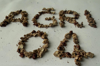 Tıp dünyası şokta: Tek böbrekten 295 taş çıktı!