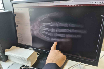 Eskişehir’de Her Ay 5–7 Çocuk Kanser Tanısı Alıyor