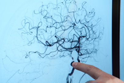 Her 20 Kişiden Birinde Gizli Tehlike: Beyin Anevrizması