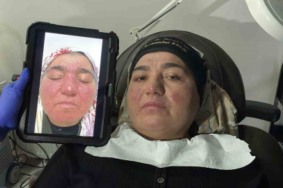 Gül Hastalığı Kabusu Sivas'ta Son Buldu: 20 Yıl Sonra Gelen Mutluluk