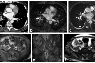 Türk Doktordan Büyük Başarı: Akciğer Pıhtısında Radyasyonsuz Teşhis!