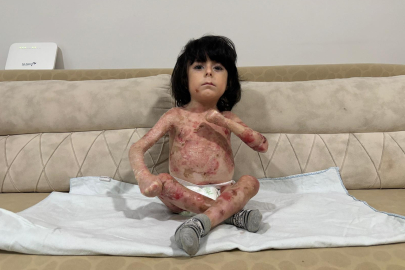 Bursa'da Kelebek Hastası 4 Yaşındaki İbrahim Yardım Bekliyor