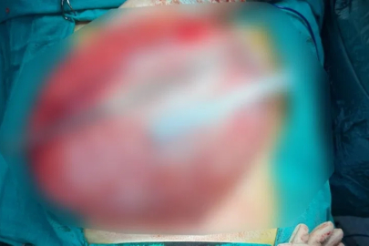 Kilo Vermek İçin Gitti, Karnından 3,5 Kiloluk Kist Çıktı