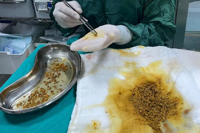 Safra Kesesinden Tam 2 Bin 67 Taş Çıkarıldı