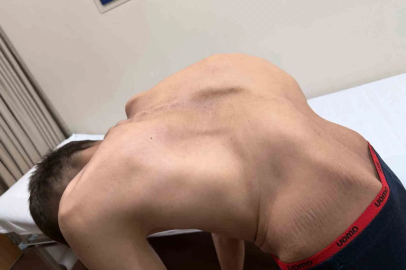 18 Yıllık Skolyoz Çilesi Ankara'daki Ameliyatla Bitti