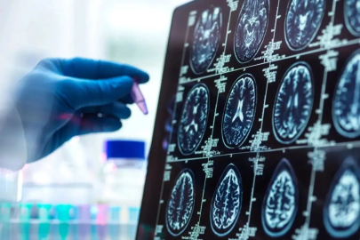 Alzheimer'ın Gizli Evresi Deşifre Oldu!