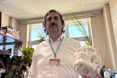Beyin tümörü ameliyatı sonrası çöken alnı, 3 boyutlu implantla düzeltildi
