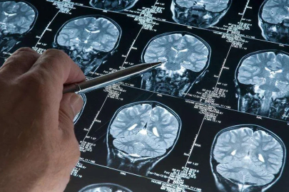 Araştırma: Derin uyku Alzheimer’ı yavaşlatıyor