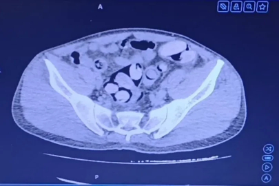 Midesinden 1 kilo uyuşturucu çıktı
