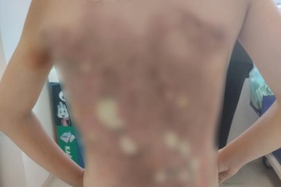 Arnavutköy’de akran zorbalığı iddiası: 12 yaşındaki çocuğun sırtını kolonya ile yaktılar
