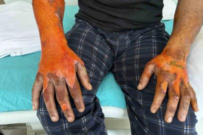 Akü patlaması, vücudunun yüzde 25’i yandı: "Bomba gibi patlamalar, kendimi zor kurtardım"
