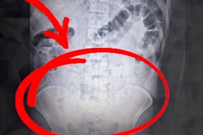 Uyuşturucuyu midelerinde taşıdılar: 4 tutuklama
