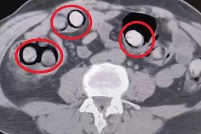 Mide ve bağırsaklarından 758 gram uyuşturucu çıktı

